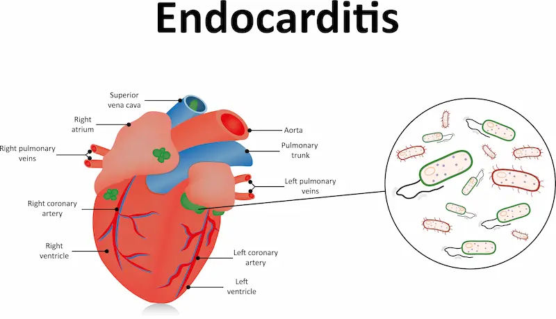 Infective Endocarditis Overview and Management